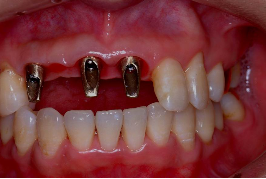 Implant Bridge Solution